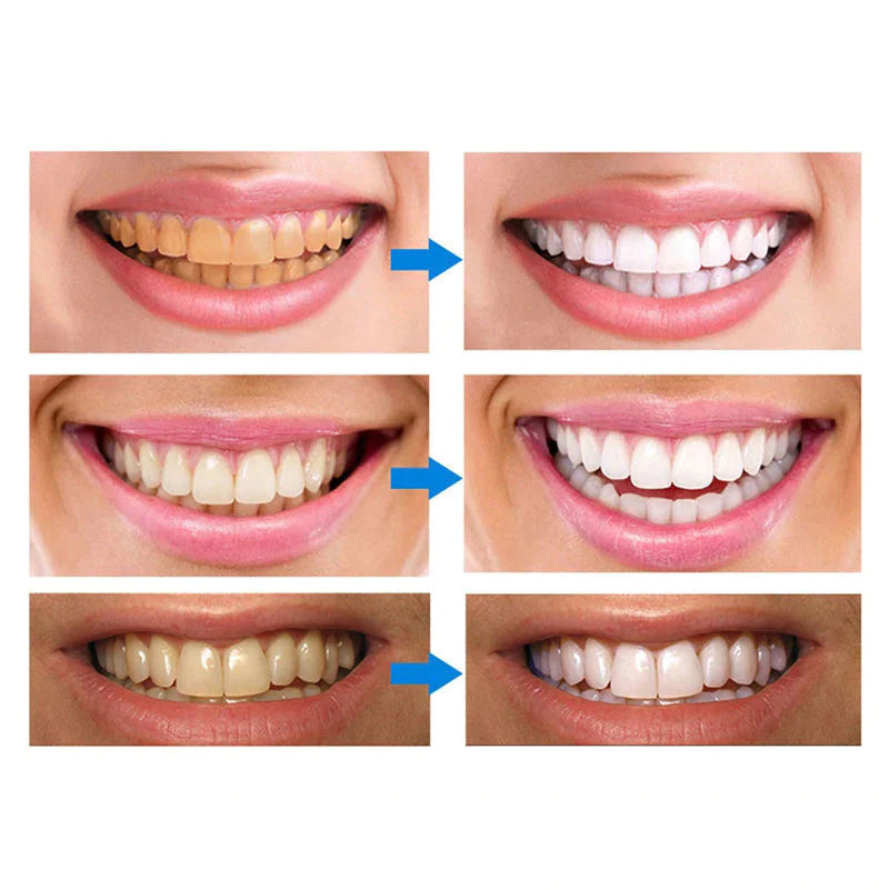 Stylo de Nettoyage et de Blanchiment des Dents
